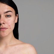 Tanpa Disadari, 4 Ini Kebiasaan yang Bikin Jerawat Makin Parah