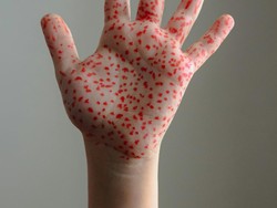 3 Gejala Penyakit Kusta yang Perlu Diwaspadai