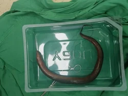 Ngeri Banget! Dokter Temukan Belut Berenang di Perut