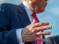 Penampakan Kondisi Trump: Tangan Memar-Kaki Bengkak, Ada Penyakit Ini