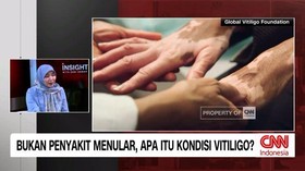 VIDEO: Bukan Penyakit Menular, Apa Itu Kondisi Vitiligo?