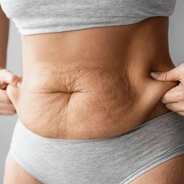 3 Cara Menghindari Kulit Bergelambir saat Menurunkan Berat Badan