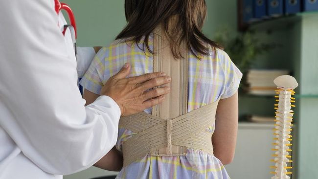 Mengenal Vertebral Body Tethering (VBT), Inovasi Terkini dalam Penanganan Skoliosis Anak