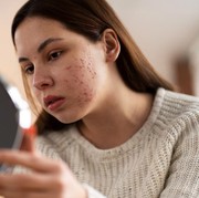 Jangan Sampai Salah Pilih Lagi, Ini 4 Rekomendasi Bahan Alami di Skincare untuk Kulit Berjerawat