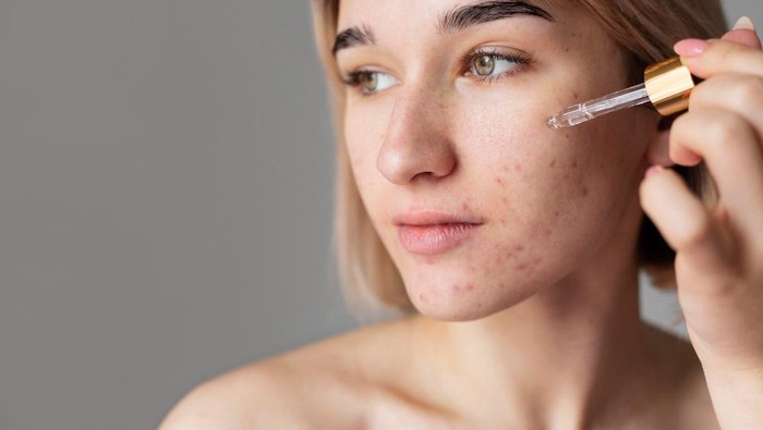 BeauPicks: 4 Rekomendasi Paket Skincare untuk Merawat Kulit Berjerawat dengan Tepat