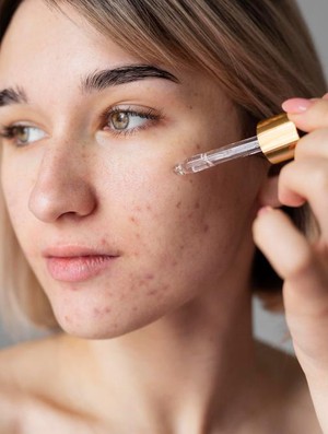 BeauPicks: 4 Rekomendasi Paket Skincare untuk Merawat Kulit Berjerawat dengan Tepat