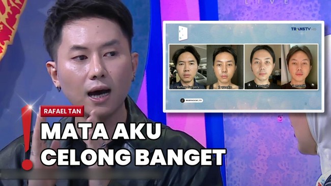 Oplas di Korea, Rafael Tan Ubah Bagian Mata-Hidung Gegara Ini