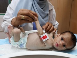 Kondisi Mengenaskan Bayi Malnutrisi di Gaza, Lengannya Cuma Sebesar Ibu Jari