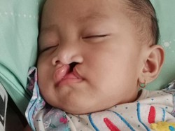Balita Khalisa Masih Perlu 3 Kali Operasi Bibir Sumbing, Ayo Bantu