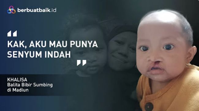 Khalisa, balita 18 bulan yang menderita bibir sumbing sejak lahir ini menanti uluran tangan Anda untuk berdonasi lewat Berbuatbaik.