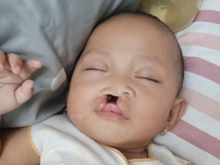 Khalisa Balita Sumbing Ingin Tersenyum Lebih Indah Seperti Anak Lainnya