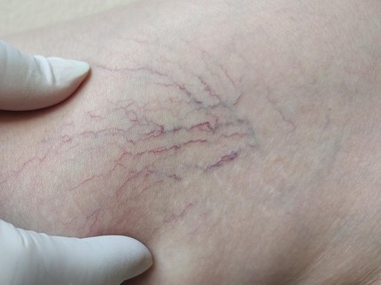 Dokter Sebut 50 Persen Manusia di Dunia akan Sakit Varises, Ternyata Ini Penyebabnya