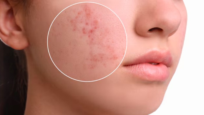 PIE dan PIH bisa dibedakan melalui warnanya. Perbedaan warna ini disebabkan peradangan akibat jerawat/Foto: freepik.com/New Africa
