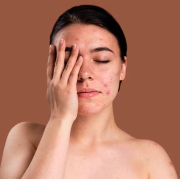 Bekas Jerawat Nggak Kunjung Pudar? Stop 5 Kebiasaan Buruk Ini Sekarang Juga!