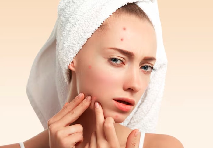 Memencet jerawat/Foto: freepik.com/wayhomestudio