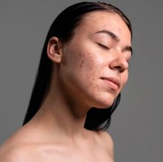 PIE vs PIH, Ini Beda Jenis Bekas Jerawat yang Wajib Kamu Tahu