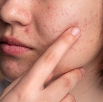 Menurut Dermatolog, Ini Kebiasaan Sehari-hari yang Bisa Bikin Jerawat Muncul