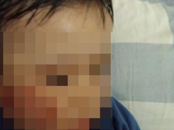 Miris Anak 1 Tahun Penuh Luka Saat Pulang dari Daycare Surabaya