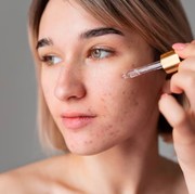 BeauPicks: 4 Skincare untuk Hilangkan Bekas Jerawat dengan Kandungan Juara