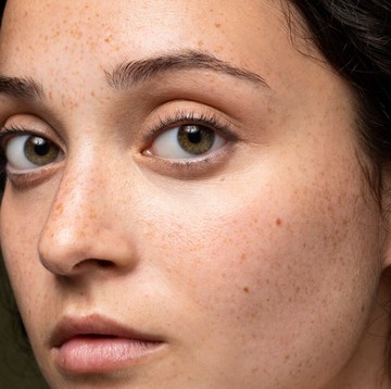 5 Cara Menghilangkan Flek Hitam agar Wajah Kembali Cerah Tanpa Noda