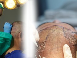 Hukum Transplantasi Rambut dalam Agama Islam, Bolehkah?