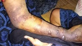 7 Warga Badui Meninggal Akibat Gigitan Ular Tanah