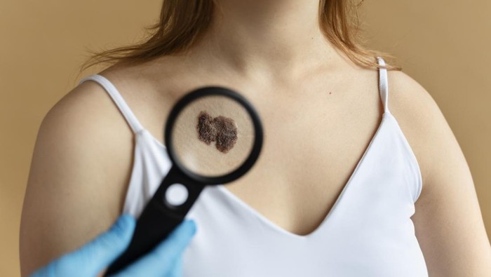 Jangan Remehkan, Ini 7 Tanda Awal Kanker Kulit yang Perlu Diwaspadai