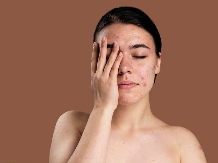 Alih-alih membiarkan jerawat meradang begitu saja, ada baiknya merawat kulit berjerawat mulai dari dasarnya. Sebelum bertambah parah, mulailah gunakan produk skincare yang diformulasikan khusus mengatasi jerawat.