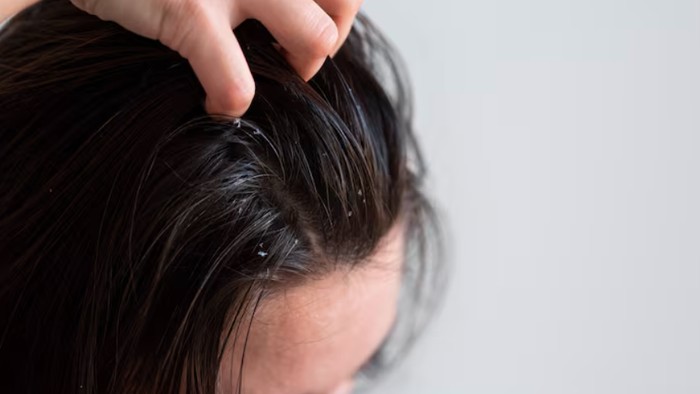 Bahaya memakai dry shampoo sembarangan. Bisa sebabkan residu yang Menumpuk/Foto: freepik.com/freepik