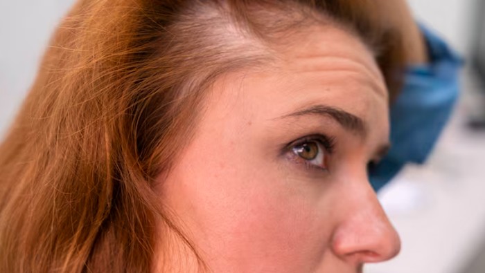 Bahaya memakai dry shampoo sembarangan. Bisa tingkatkan risiko Iritasi, infeksi, dan kerontokan/Foto: freepik.com/freepik