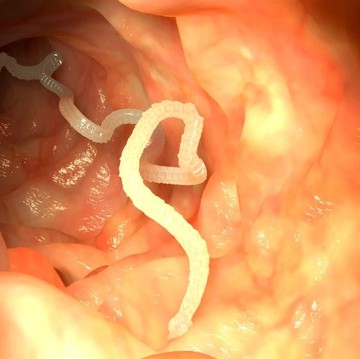 11 Ciri Cacingan pada Orang Dewasa yang Perlu Diwaspadai