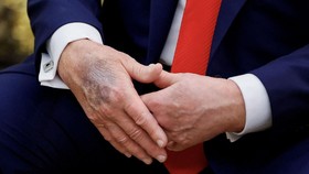 Trump Lagi-lagi Muncul di Publik dengan Tangan Memar, Sakit Apa?