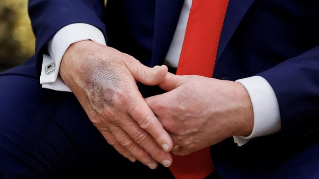 Tangan Trump kembali tampak memar saat menjamu kedatangan Presiden Korsel Lee Jae Myung di Oval Office.