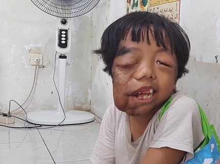 Dirundung Mirip Alien, Anak Tukang Ojek Ingin Hidup dengan Rasa Aman