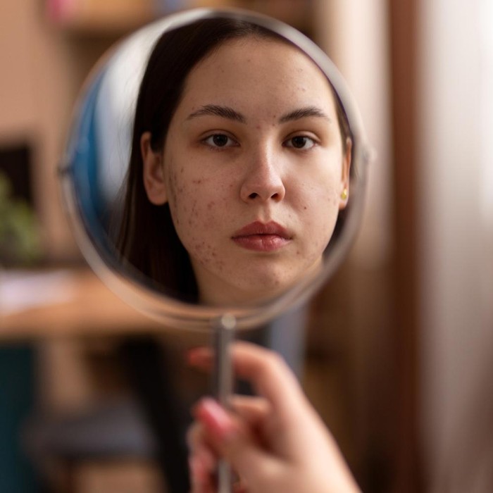 Bintik hitam di wajah atau hiperpigmentasi. Ini penyebab dan cara menghilangkannya yang aman dan efektif untuk dicoba.