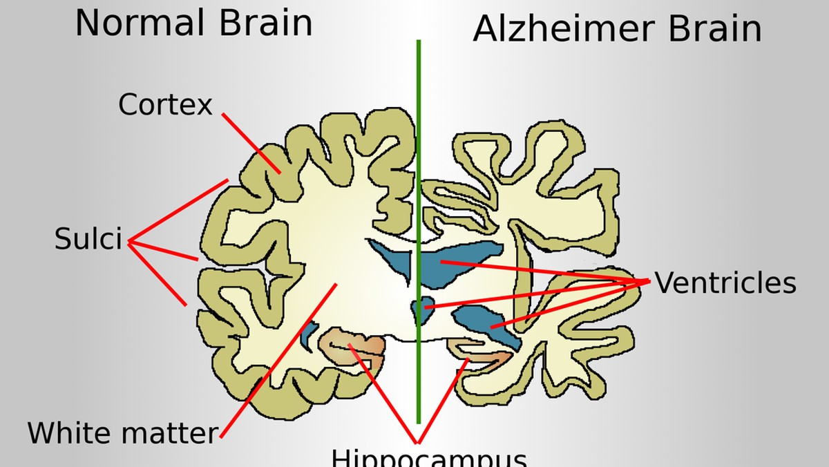 Sering Lupa dan Bingung? Kenali 10 Gejala Awal Alzheimer dan Demensia