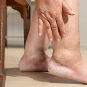 Jangan Remehkan, Kaki Bengkak Bisa Jadi Tanda 5 Penyakit Ini
