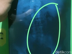 Warga Batang Syok Divonis HIV Usai Operasi Kencing Batu, Ternyata...