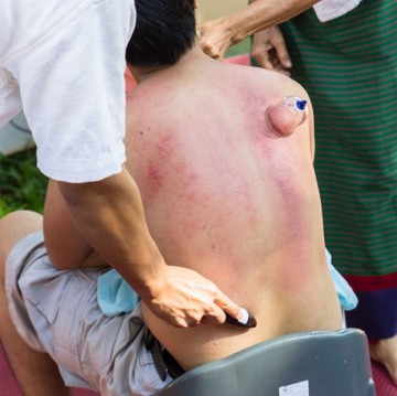 Hati-Hati, 8 Bahaya Kerokan yang Sering Tidak Disadari Banyak Orang