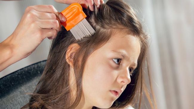 Kutu Rambut: Gejala, Penyebab, dan Cara Mengatasinya pada Rambut Anak