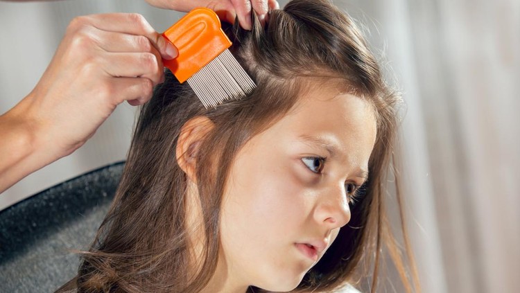 Kutu rambut Gejala dan pengobatan kutu rambut