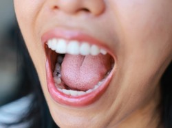 Viral Punya Pasangan Gigi Berlubang Disebut Bisa Menular, Begini Kata Dokter Gigi