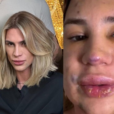 Influencer Meninggal Usai Komplikasi Prosedur Kecantikan hingga Wajah Bengkak