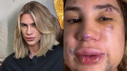 Influencer Meninggal Usai Komplikasi Prosedur Kecantikan hingga Wajah Bengkak