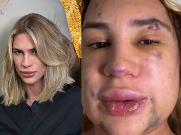 Influencer Meninggal Usai Komplikasi Prosedur Kecantikan hingga Wajah Bengkak