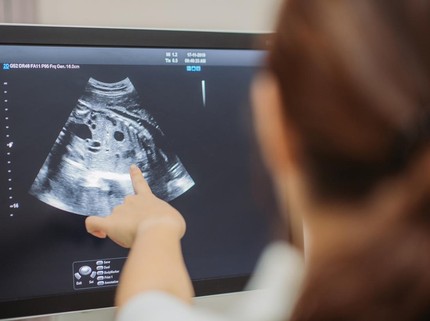 Penyebab Terjadinya Kehamilan Kimiawi Usai Program IVF, Kenali juga Gejalanya