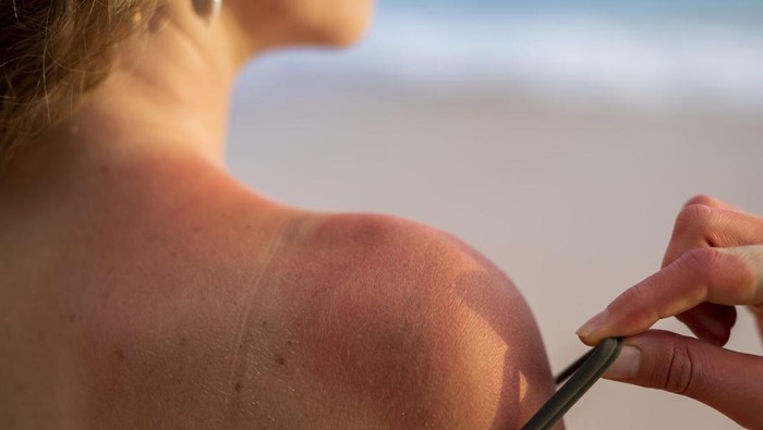 Gejala heat stroke yang perlu dikenali. Termasuk kulti memerah akibat panas hingga sakit kepala.