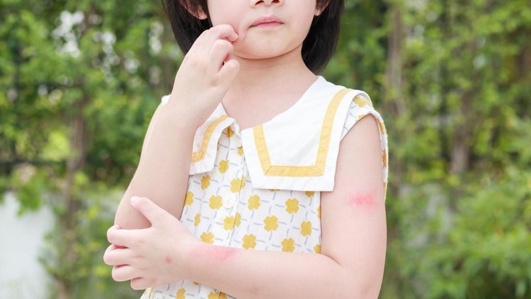 Alergi pada anak Alergi pada anak