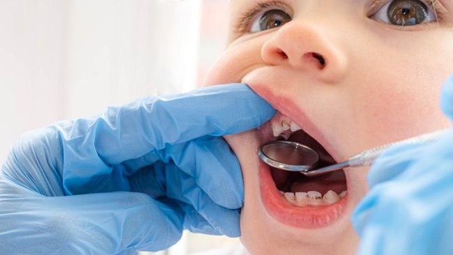 Karies pada Gigi Anak, Kenali Gejala hingga Cara Mencegahnya