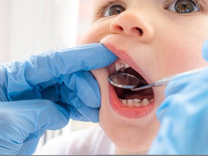 Karies pada Gigi Anak, Kenali Gejala hingga Cara Mencegahnya